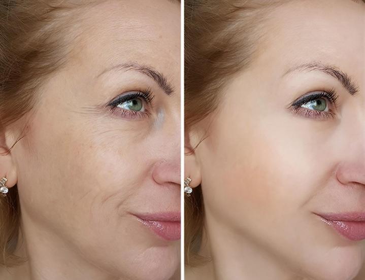 Soins d’hyperpigmentation Repentigny